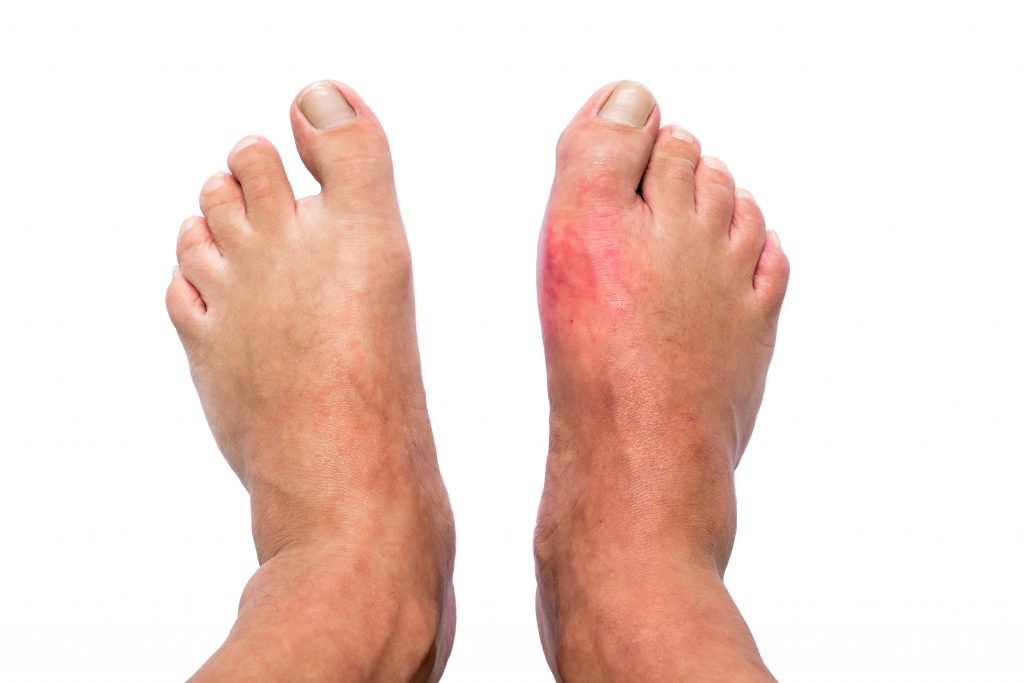 How to treat Gout?